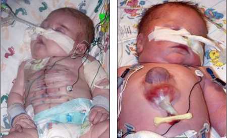 Miracolul medicinii: S-a născut cu inima în afara corpului şi trăieşte!